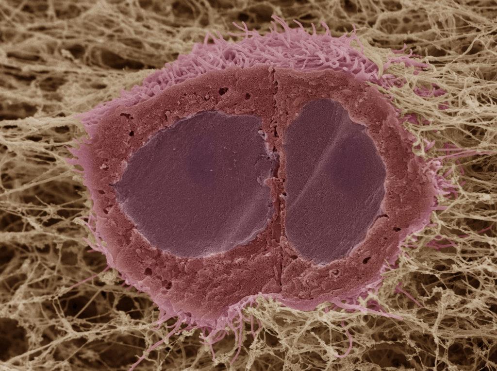 Two human squamous carcinoma cells invading into a collagen rich gel