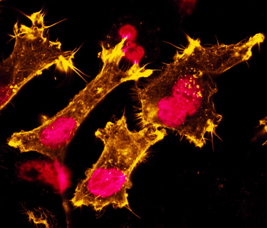 Increased F-actin staining in human bladder cancer cells after photodynamic therapy
