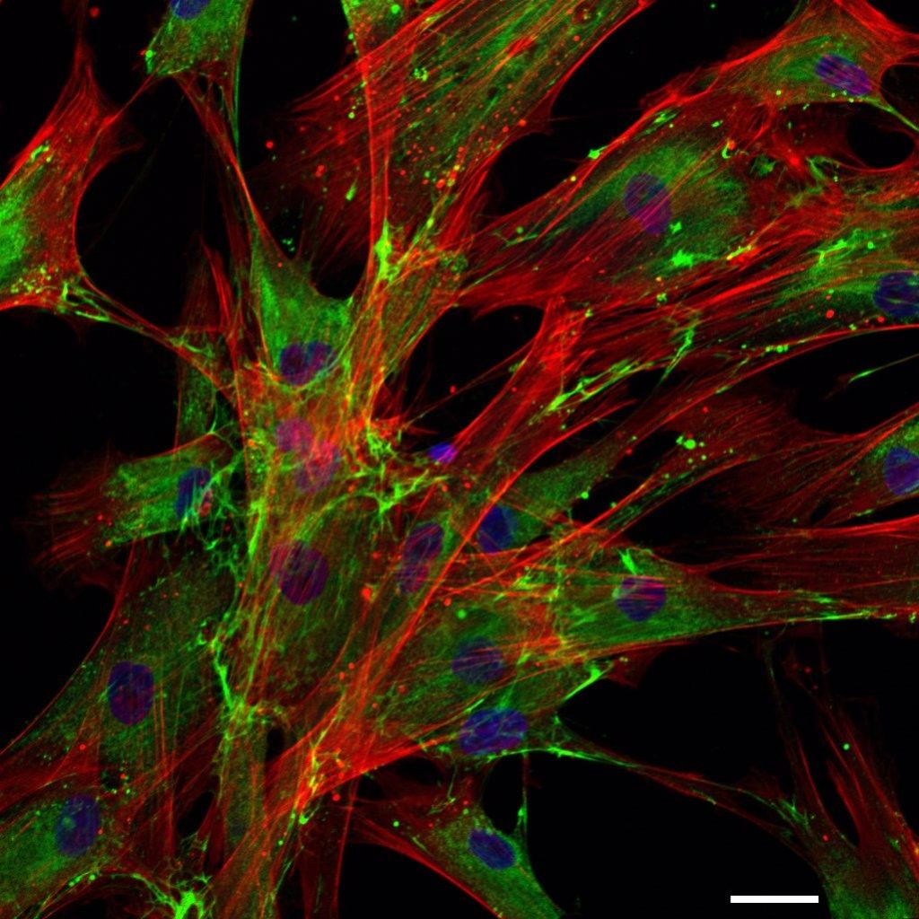Cancer-Associated Fibroblasts (CAF) Isolated from Patient with Neuroblastoma