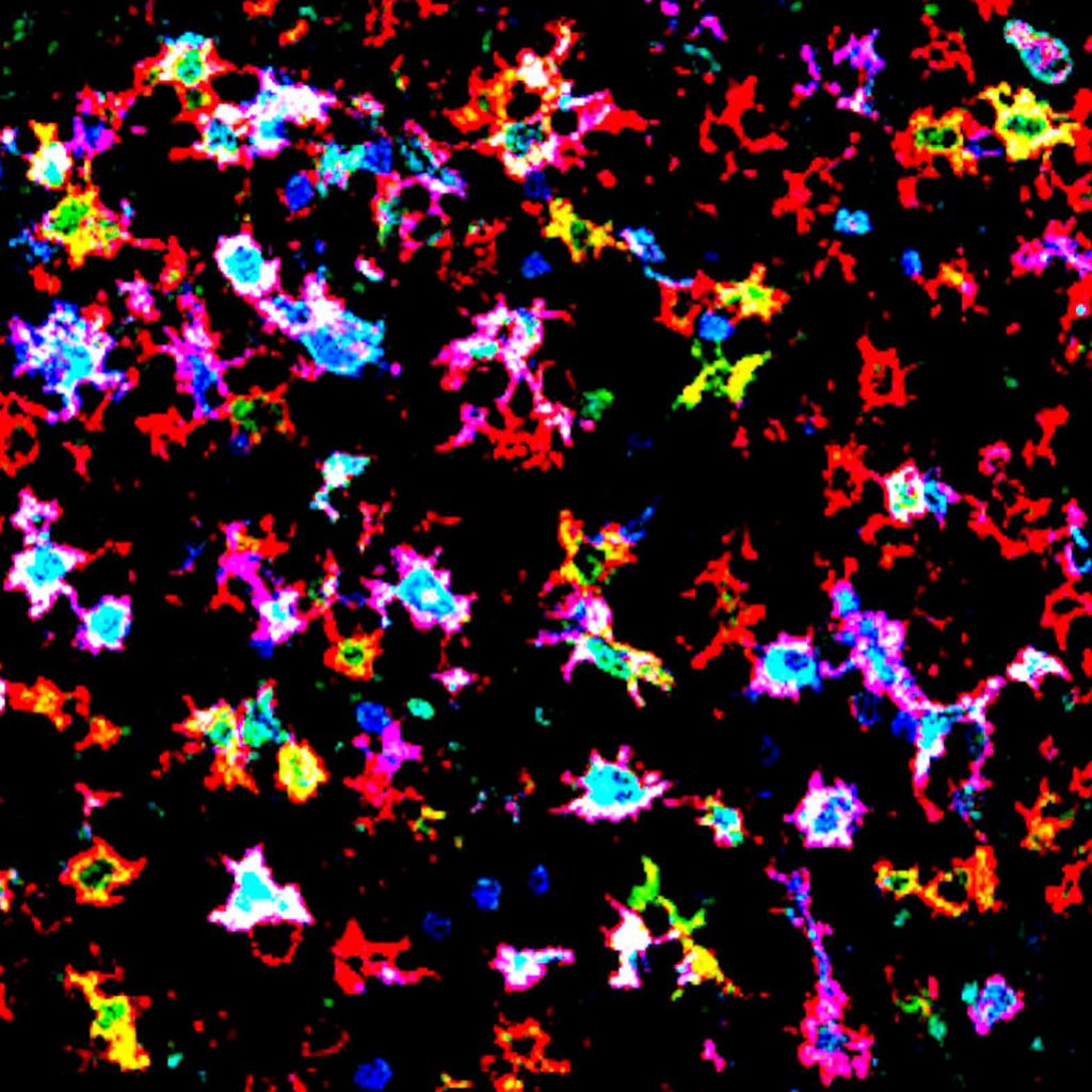 Macrophages and dendritic cells in lymph node follicle of a renal cancer patient