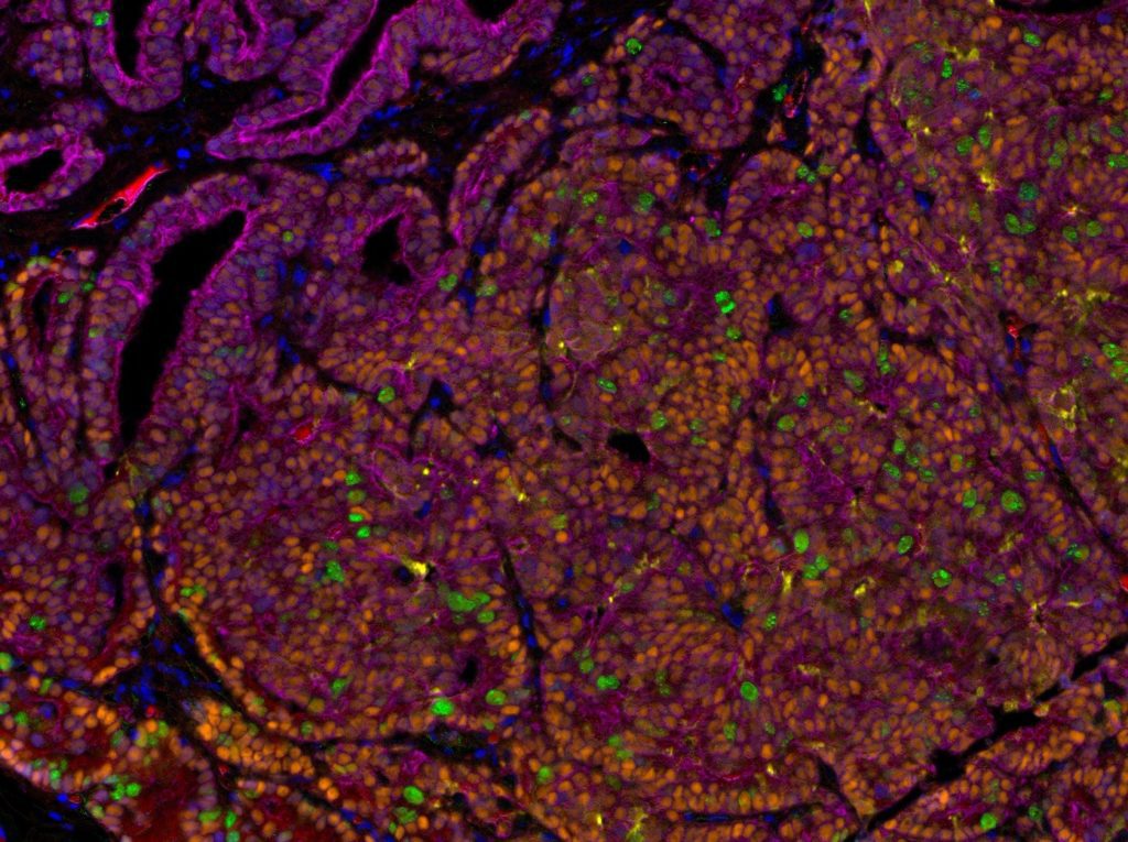 Multispectral immunofluorescent image of a lung prostate cancer metastasis