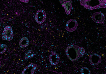 One researcher’s journey with spatial biology in endometriosis research