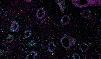 One researcher’s journey with spatial biology in endometriosis research